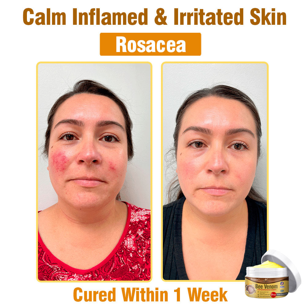 🍀 flysmus™ Bee Venom Comprehensive Cream 🇺🇸 Dermatologist Recommended