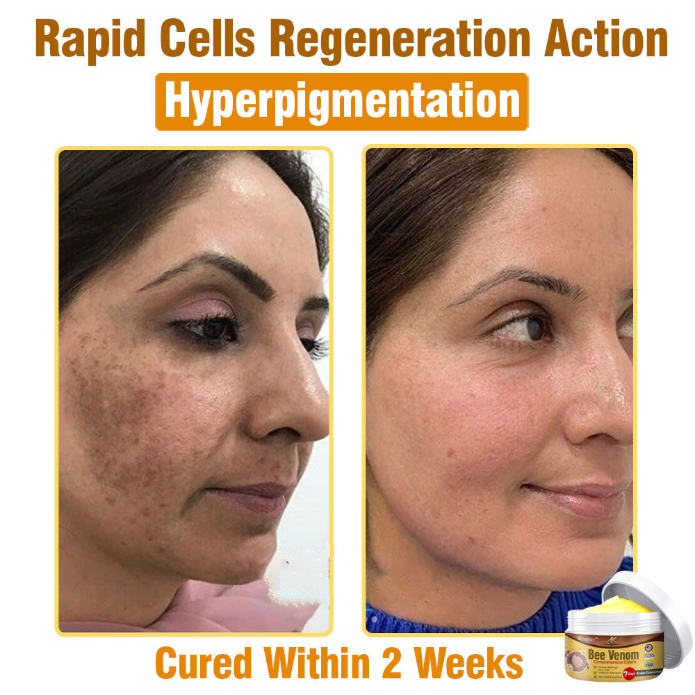 🍀 flysmus™ Bee Venom Comprehensive Cream 🇺🇸 Dermatologist Recommended