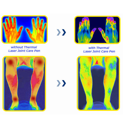 GFOUK™ MedicWave Thermal Laser Joint Care Pen